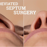 Deviated Septum Surgery | Also Known as Septoplasty, is a Procedure That Straightens The Nasal Septum. The Surgery Can Improve Breathing & Relieve Nasal Obstruction